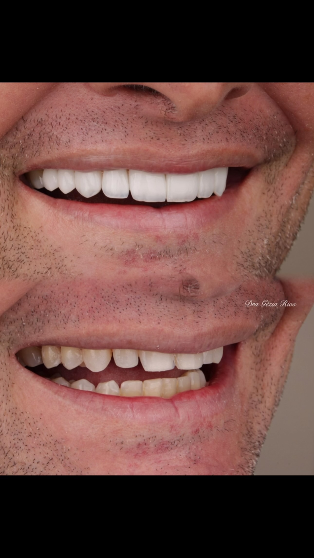 Detalhe de sorriso com lentes em resina, antes e depois, publicado pela Dra. Gezia Rios