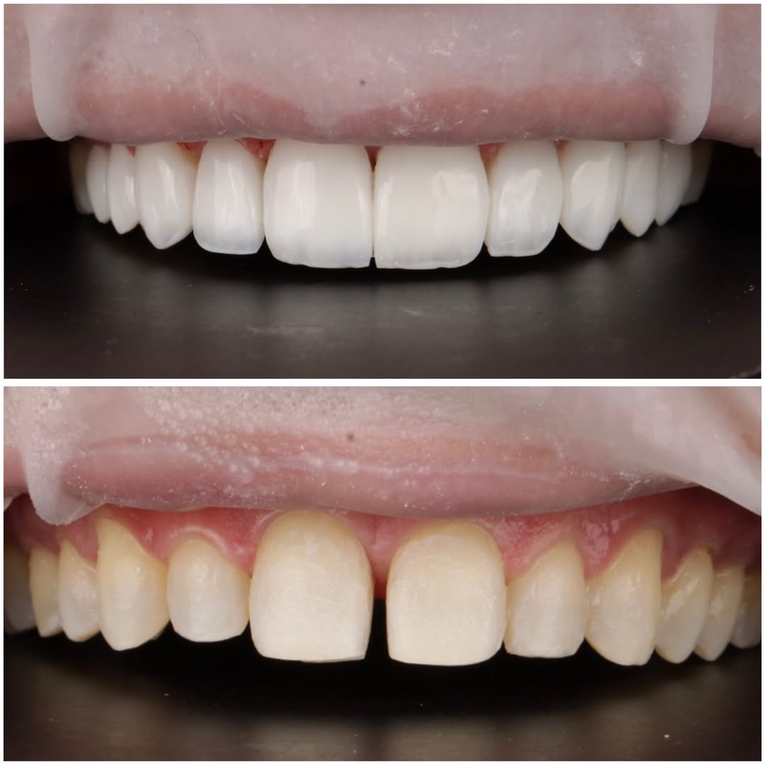 Sorriso com lentes em resina, antes e depois, publicado pela Dra. Gezia Rios