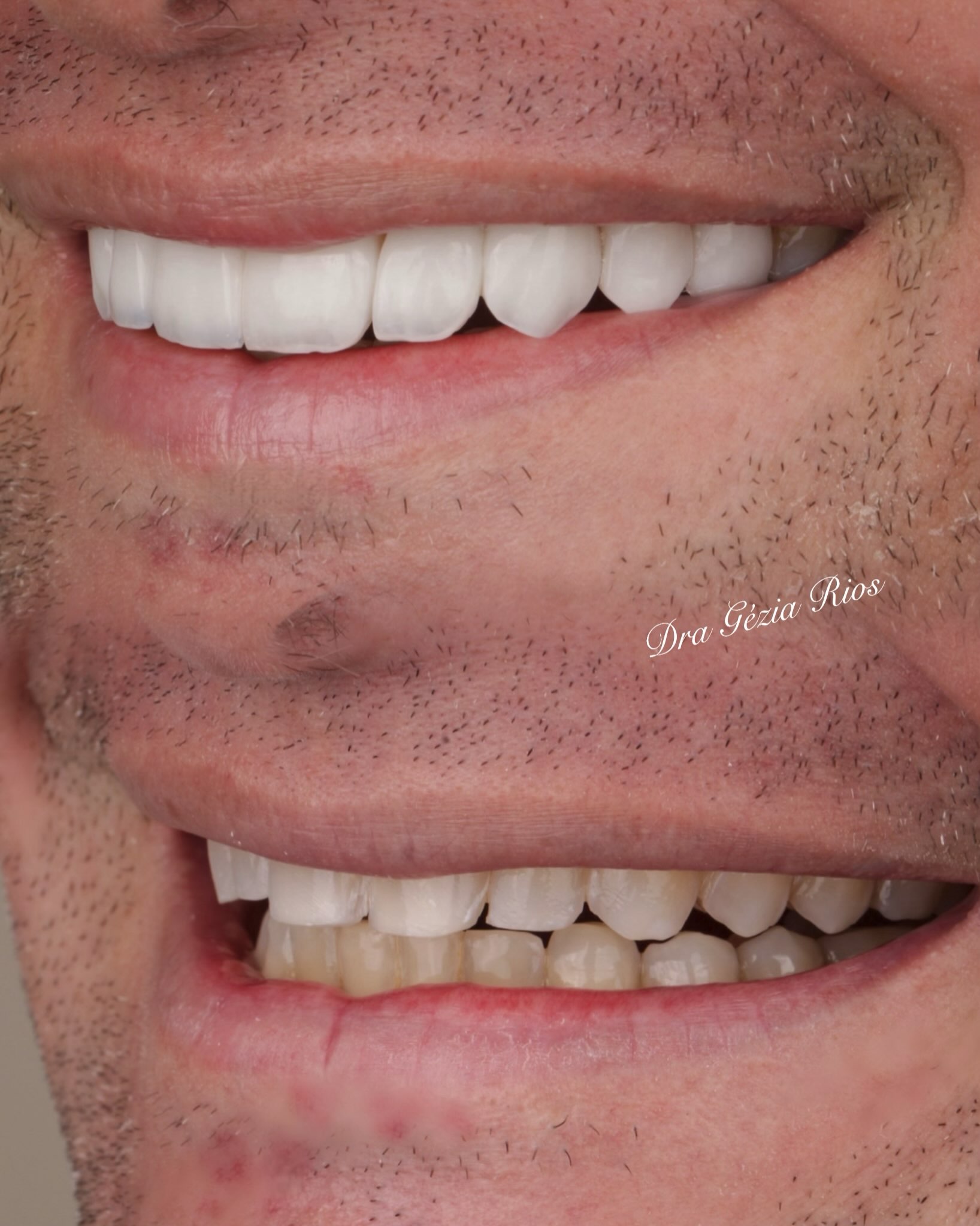 Sorriso com lentes em resina e detalhes de textura, publicado pela Dra. Gezia Rios